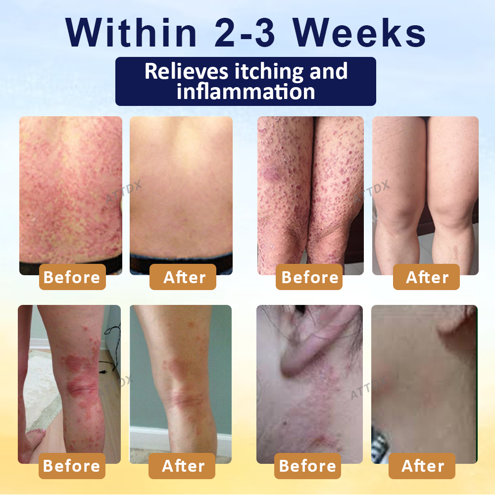 LOVILDS® Psoriasis Care Mellifera Venom Skin Healing Spray🔥