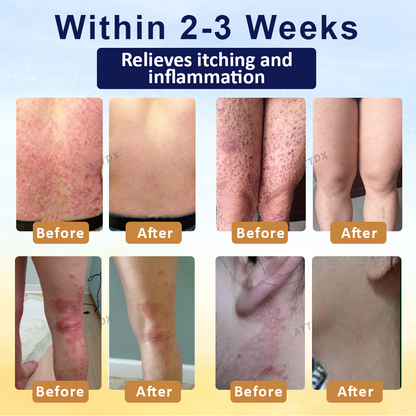 LOVILDS® Psoriasis Care Mellifera Venom Skin Healing Spray🔥