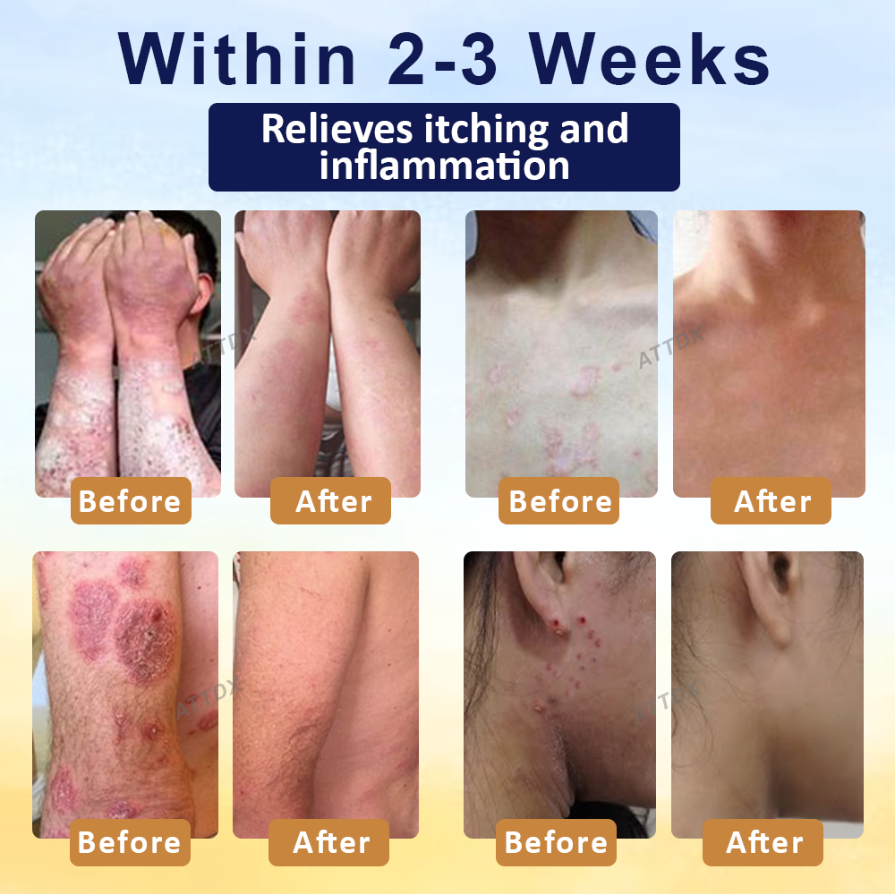 LOVILDS® Psoriasis Care Mellifera Venom Skin Healing Spray🔥