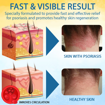 LOVILDS® Psoriasis Care Mellifera Venom Skin Healing Spray🔥